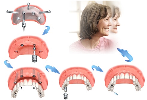 Kỹ thuật cấy ghép răng Implant nha khoa