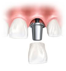Implant thay thế răng đơn lẽ