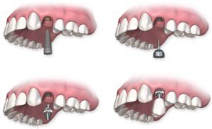 Quy trình cấy ghép răng implant nha khoa