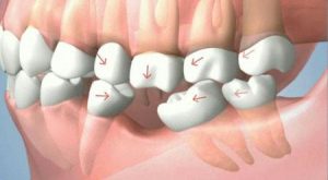 Cầu răng sứ 5